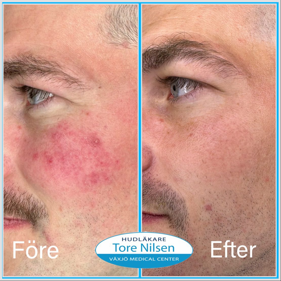 Före och efter behandling av rosacea med läkemedel och laser hos Hudläkare Tore Nilsen i Växjö.