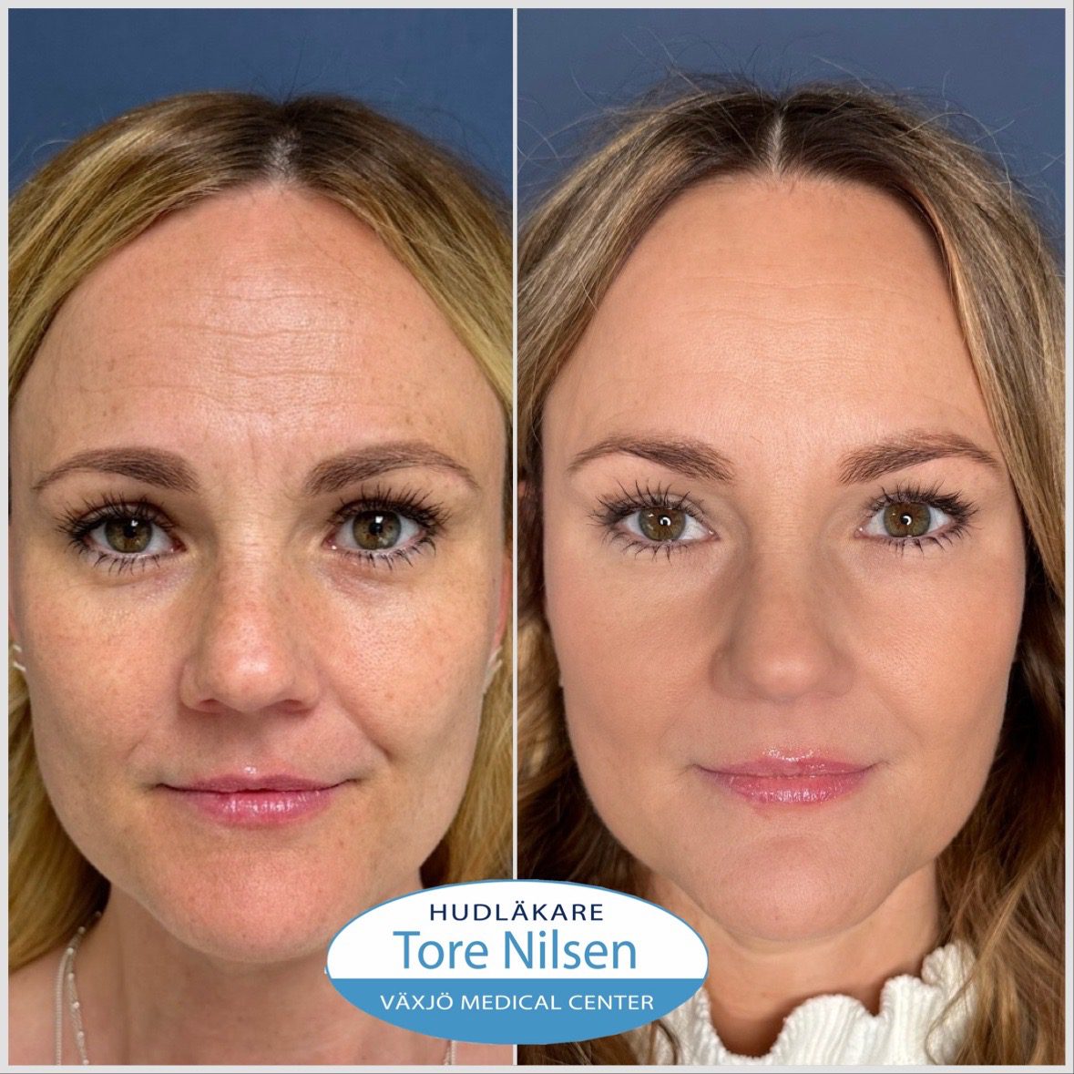 Hudläkare Tore Nilsen