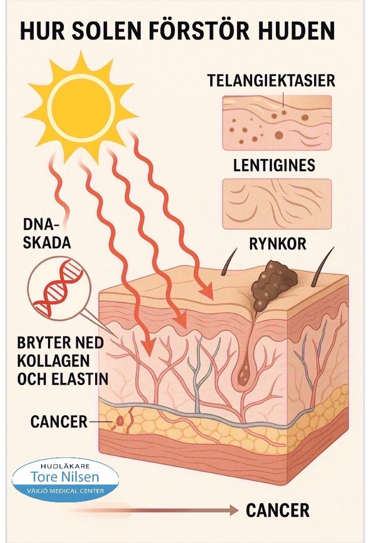 Solen förstör huden. Bilden visar hur UV-strålning från solen skadar huden i flera steg: först DNA-skador och nedbrytning av kollagen/elastin, därefter synliga förändringar som rynkor, pigmentfläckar och kärlbristningar, och slutligen utveckling av hudcancer. Illustrationerna visar hudens lager, solens strålar och typiska hudförändringar. Dr Tore.