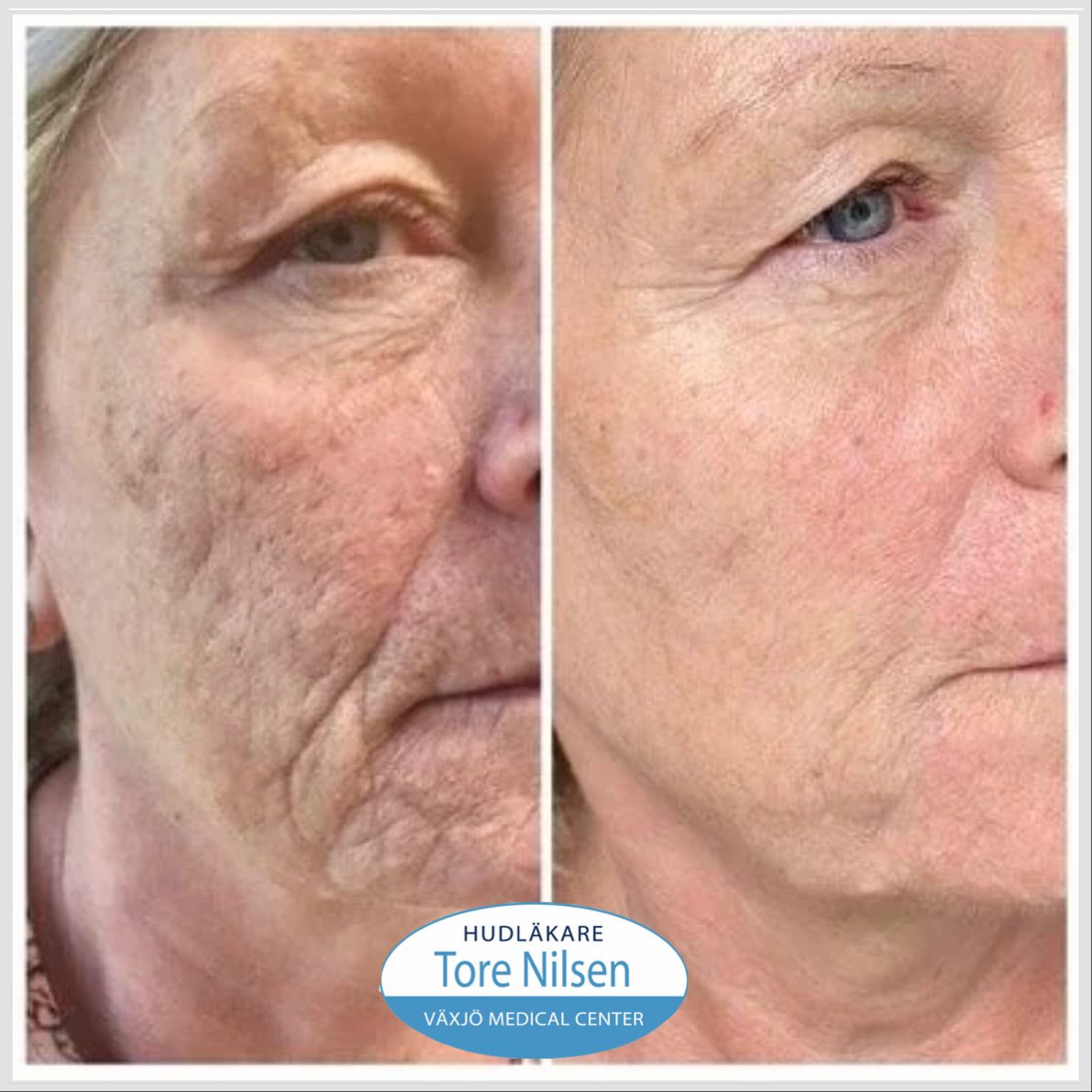 Före- och efterbild på kvinnas ansikte med tydlig förbättring av hudstruktur, rynkor och acneärr efter medicinsk laserbehandling och Restylane Skin Booster hos hudläkare Tore Nilsen i Växjö.