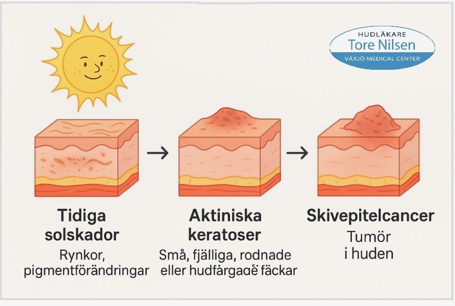 Illustration som visar hur solskador kan utvecklas från tidiga hudförändringar till aktiniska keratoser och vidare till skivepitelcancer. Dr Tore - Växjö Medical Center