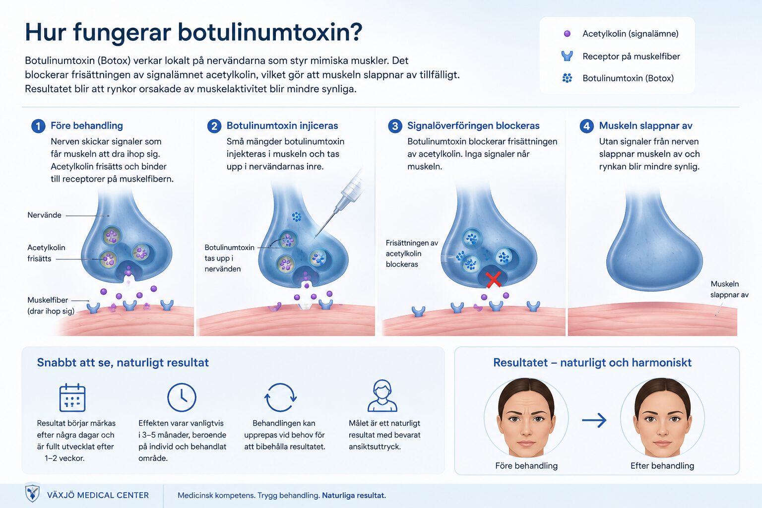Illustration som visar hur botulinumtoxin blockerar nervsignalen till muskeln och minskar muskelaktiviteten.