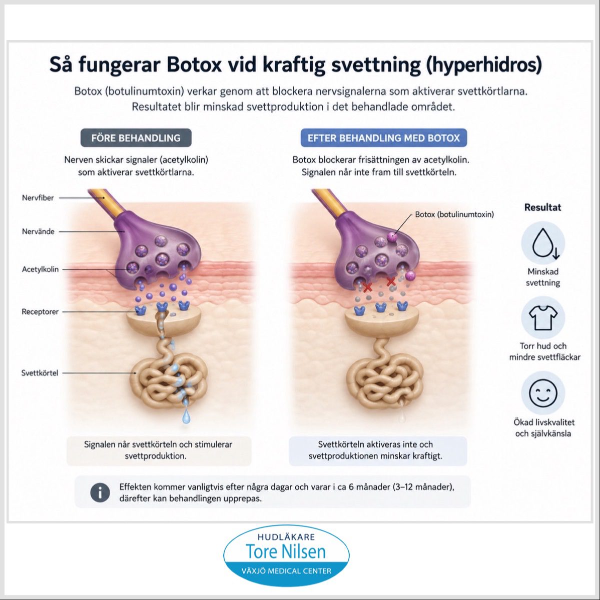 Illustration som visar hur Botox minskar svettning vid hyperhidros genom att tillfälligt blockera nervsignalerna till svettkörtlarna.