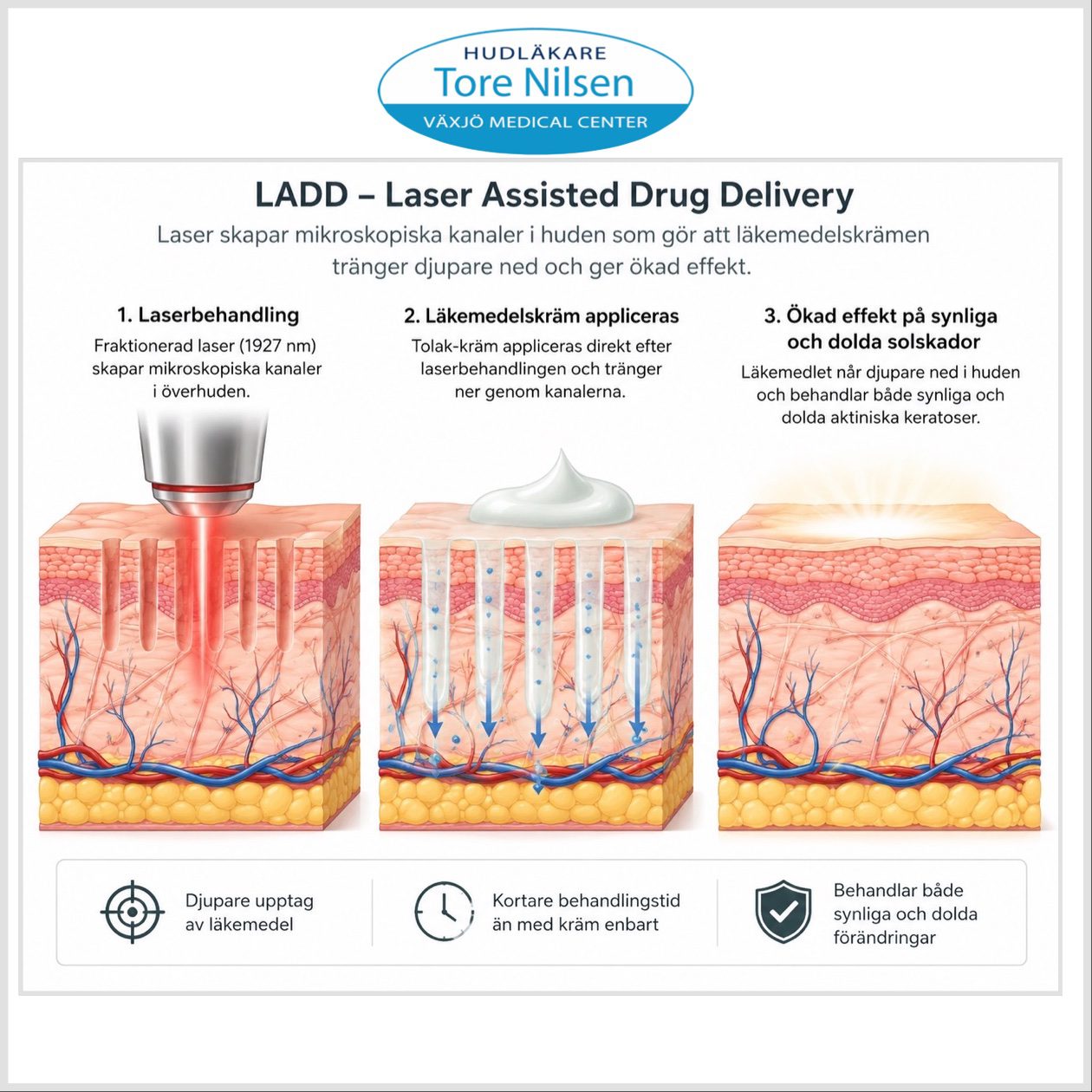 llustration som visar hur LADD-behandling med fraktionerad laser ökar upptaget av Tolak (5-fluorouracil) i huden vid behandling av aktiniska keratoser.