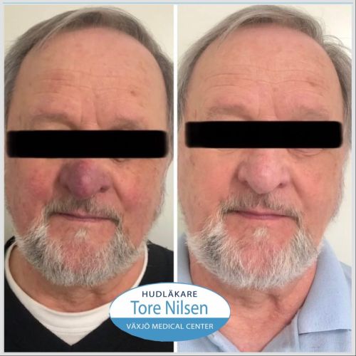 Före- och efterbild på en man med akne rosacea och blåröd missfärgning samt svullnad på näsan (misstänkt begynnande rhinophyma). Förebilden visar kraftig rodnad och kärlförändringar centralt i ansiktet. Efterbilden visar en mer neutral hudton med avsevärt förbättrad färg och struktur efter behandling med laser hos Växjö Medical Center, under ledning av hudläkare Tore Nilsen.