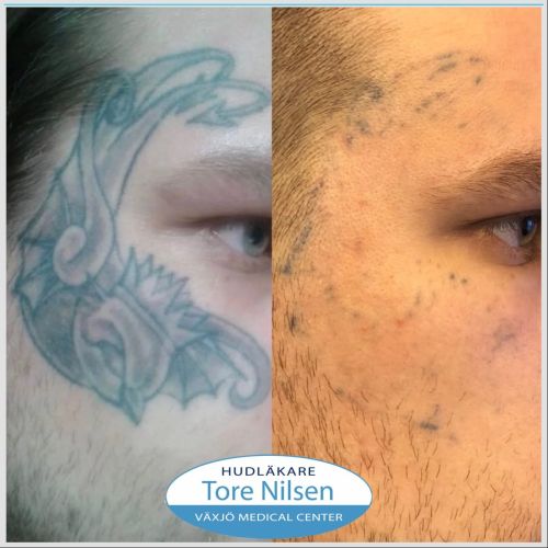 alt="Tatueringsborttagning i ansiktet med Picolaser vid Växjö Medical Center – före och efter sex behandlingar, tydlig blekning av tatueringen."