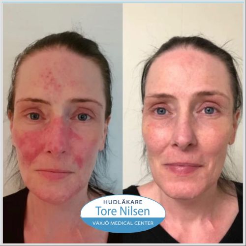 Före- och efterbild på en kvinna med rosacea med akne-liknande utslag över ansikte, kinder och panna. Förebilden visar intensiv rodnad och papulopustulösa förändringar. Efterbilden visar jämnare hudton med minskad rodnad och nästan helt läkta utslag. Behandlingen har skett hos hudläkare och kombinerat läkemedel med laserterapi.