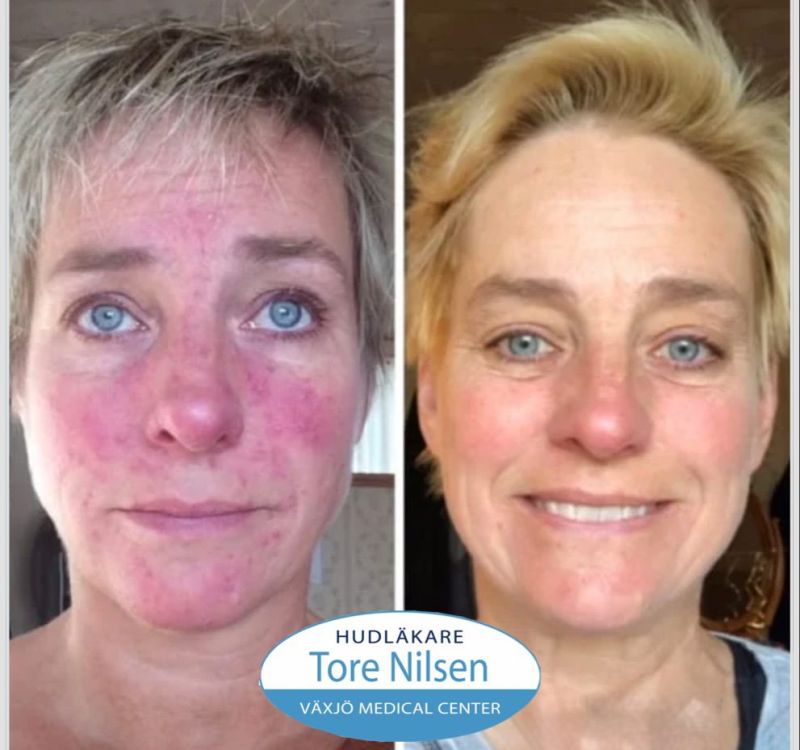 Före- och efterbild på en kvinnlig patient med utbredd rosacea i ansiktet. Förebilden visar kraftig rodnad, papler och svullnad över näsa och kinder. Efterbilden visar betydligt lugnare hud med avsevärt minskad inflammation och rodnad. Patienten har behandlats med receptbelagda läkemedel i kombination med laser hos hudläkare Tore Nilsen, Växjö Medical Center.